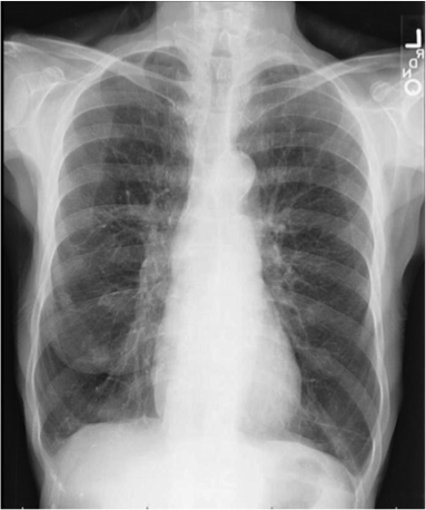Infective exacerbation copd steroids